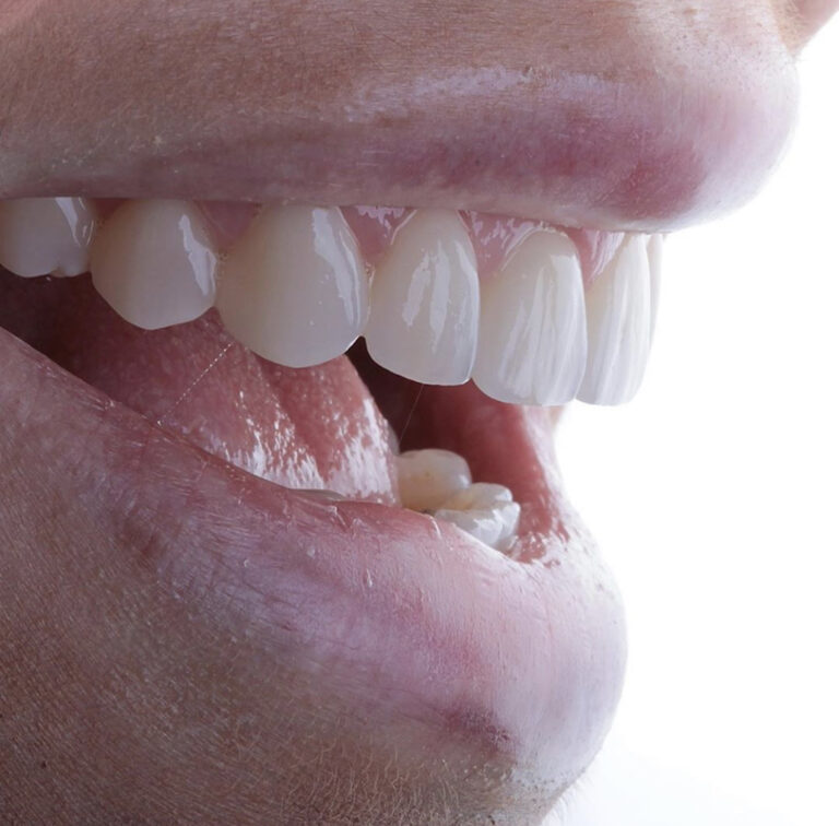 Dentallas Tandtechniek Volledige prothese of kunstgebit